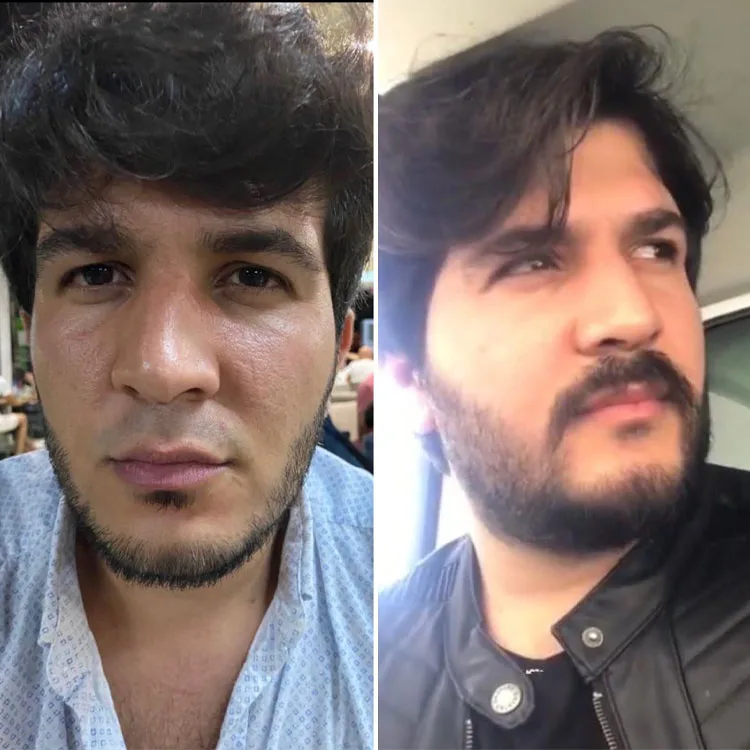 Beard And Mustache Transplant Patient 1