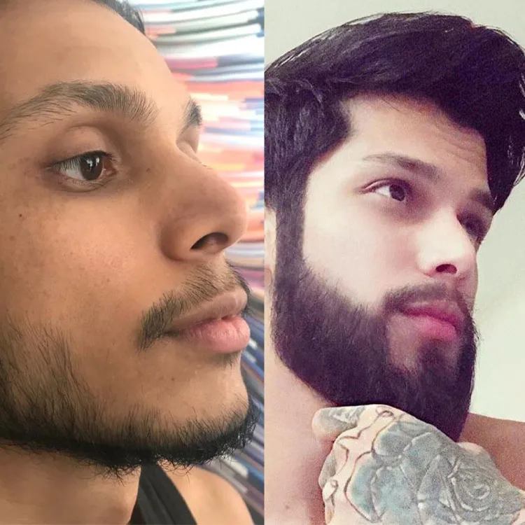 Beard And Mustache Transplant Patient 2
