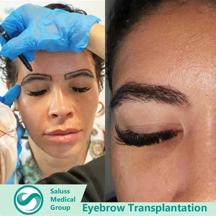 Eyebrow Transplant Patient 1