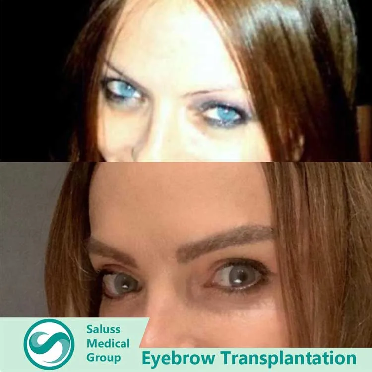 Eyebrow Transplant Patient 2
