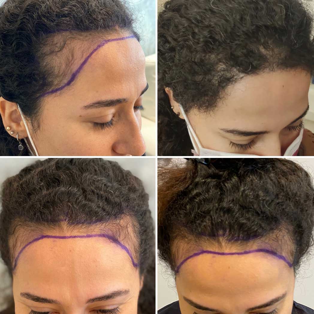 Hair Transplant For Woman Patient 1