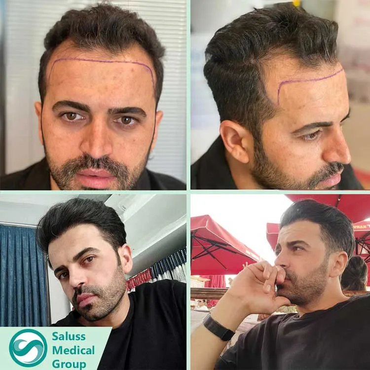 Hair Transplant Patient 1