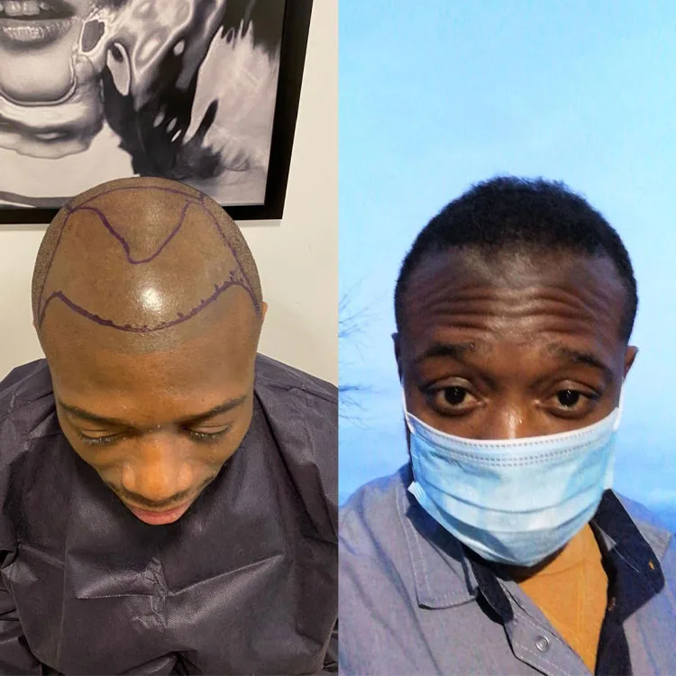 Hair Transplant Patient 15