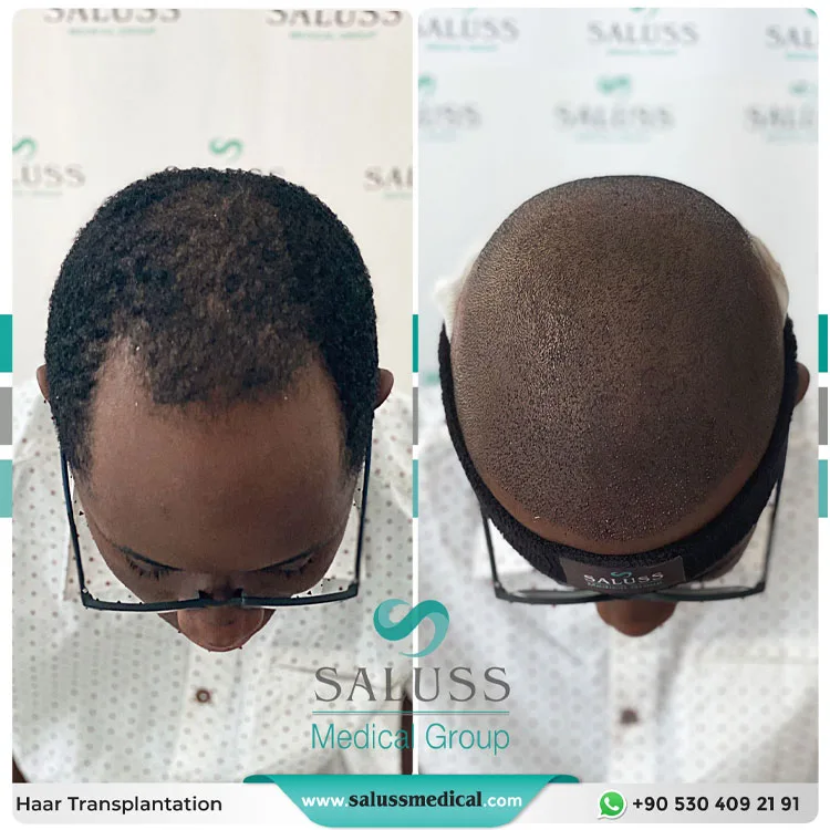 Hair Transplant Patient 17