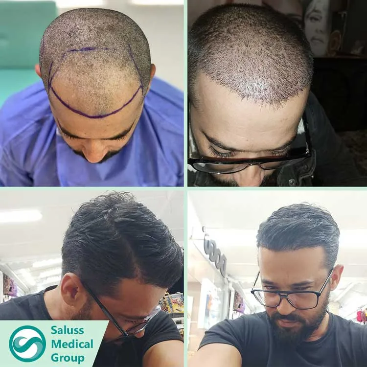 Hair Transplant Patient 3
