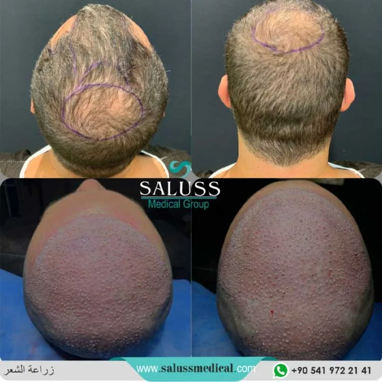 Hair Transplant Patient 4