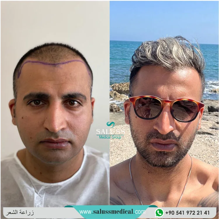 Hair Transplant Patient 8