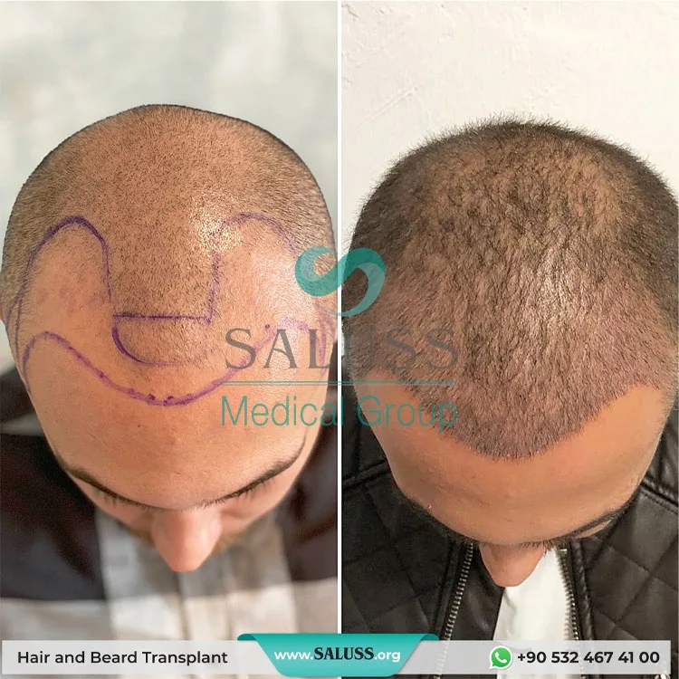 Hair Transplant Patient 9