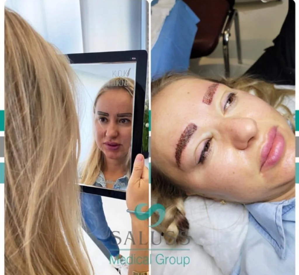 Eyebrow Transplant Patient 3