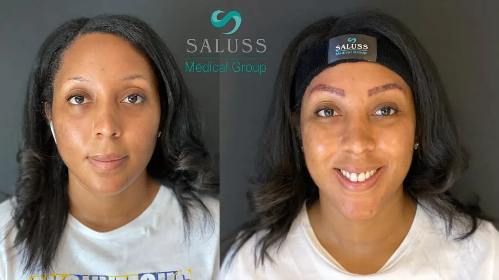 Eyebrow Transplant Patient 4