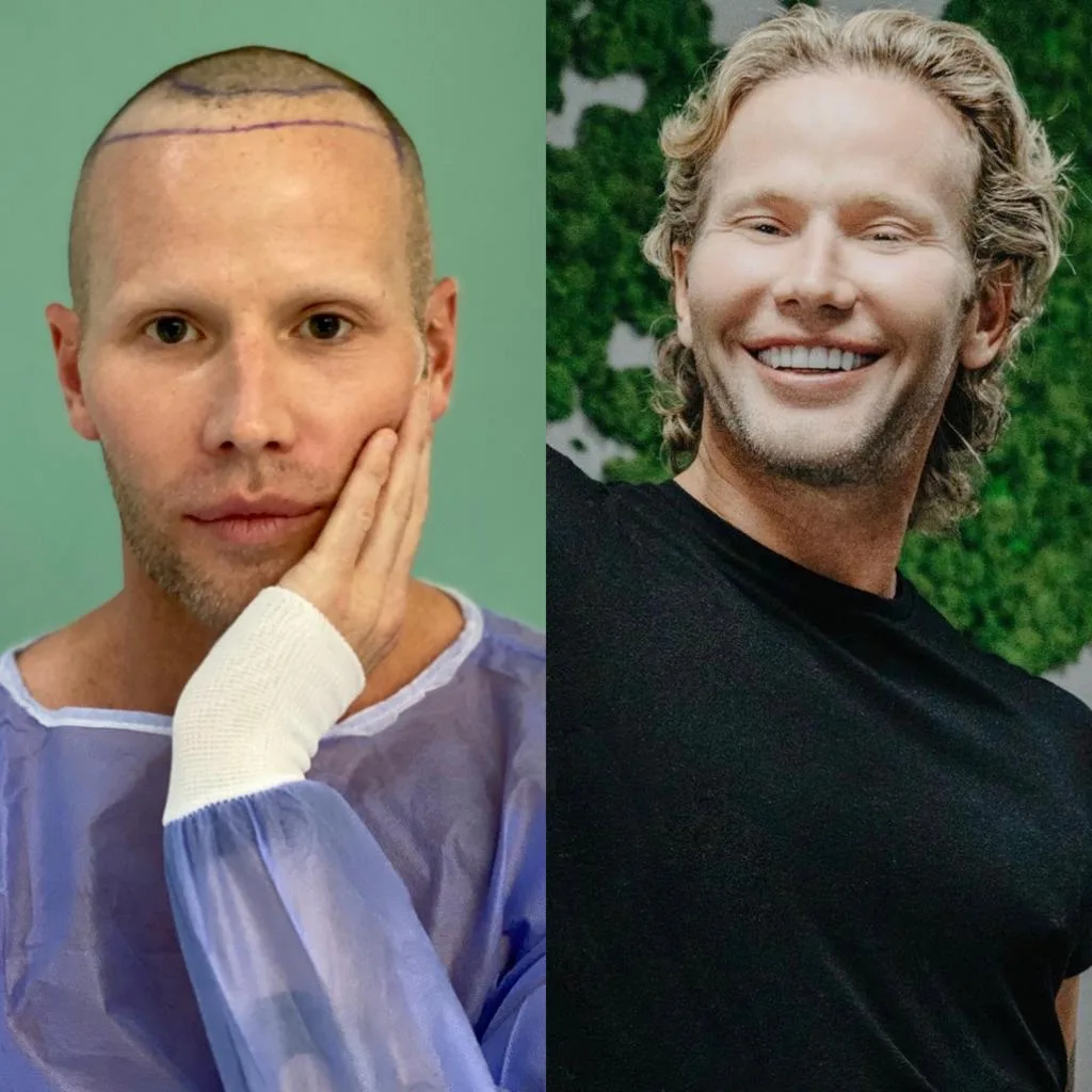 Hair Transplant patient before after 1
