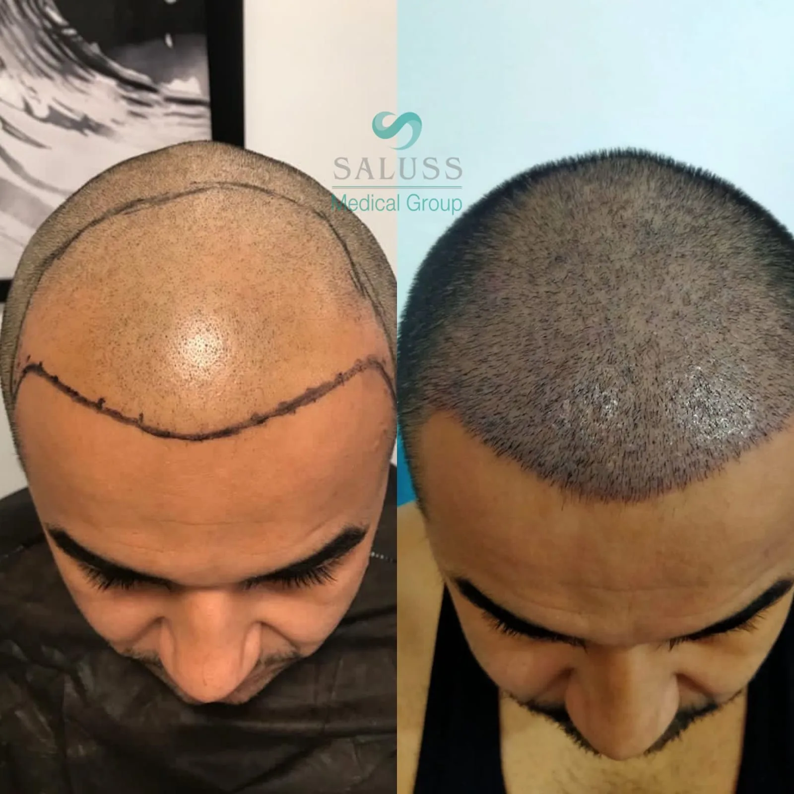 Hair Transplant patient before after 11