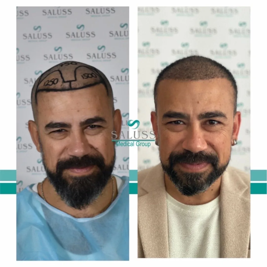 Hair Transplant patient before after 9