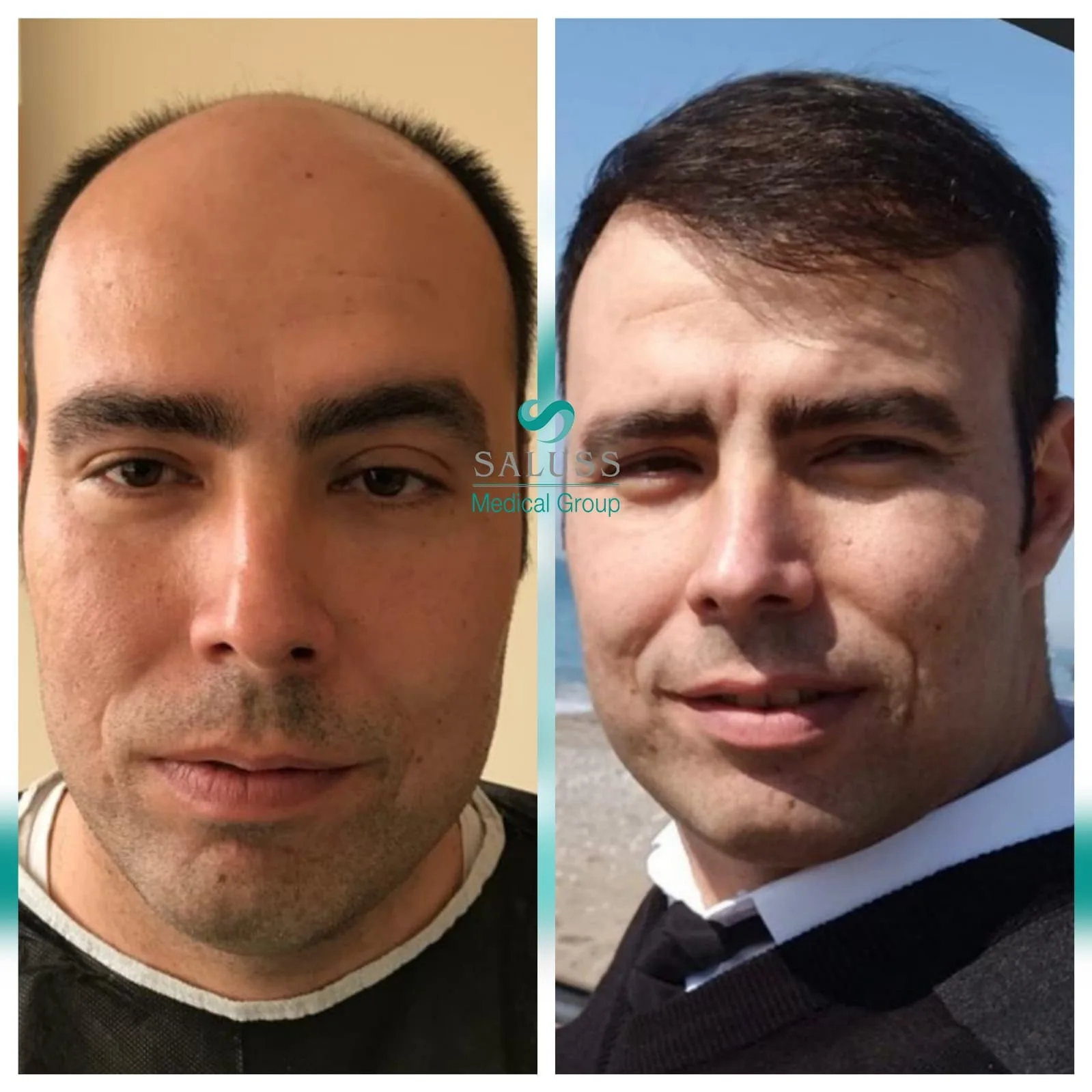Hair Transplant patient before after 10
