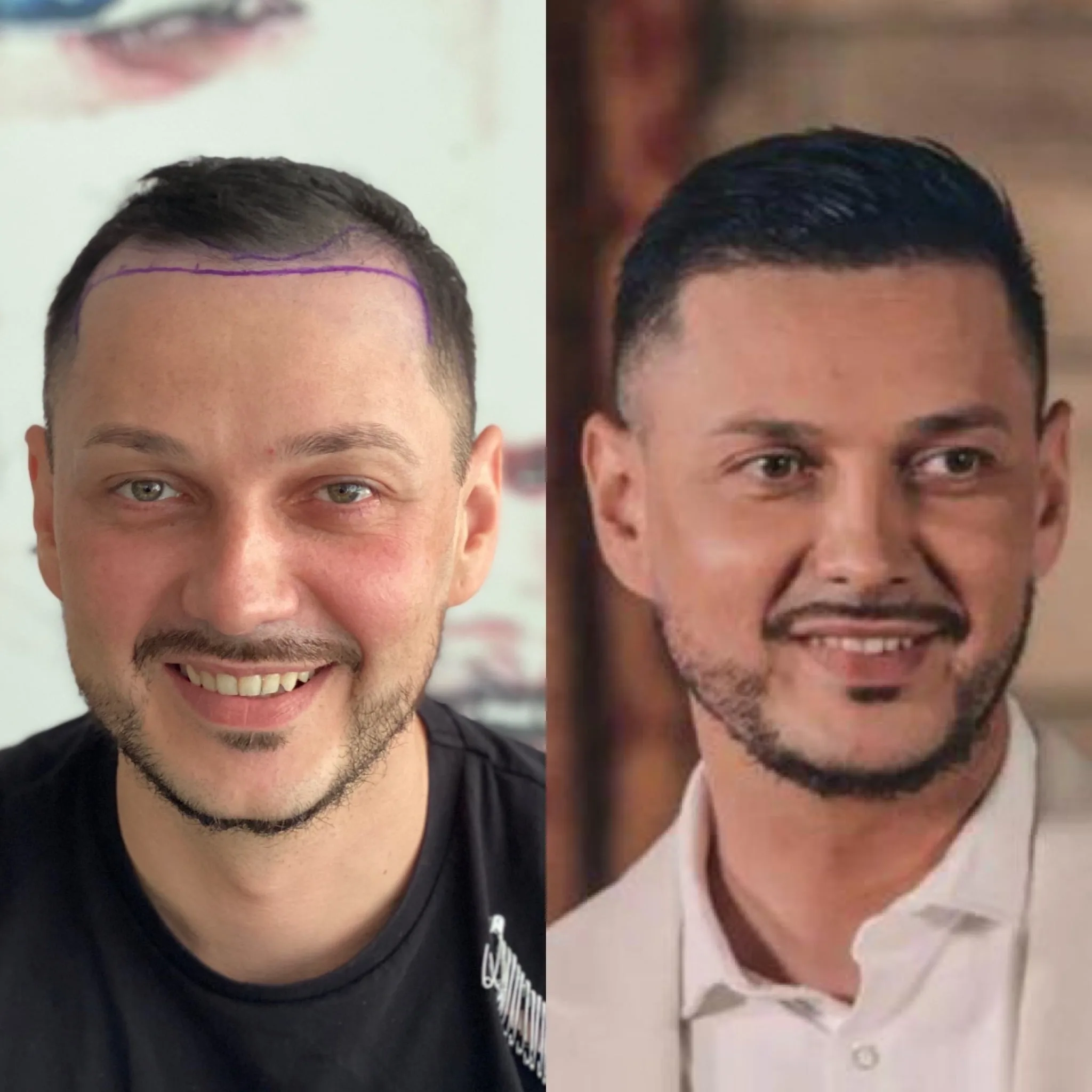 Hair Transplant patient before after 5