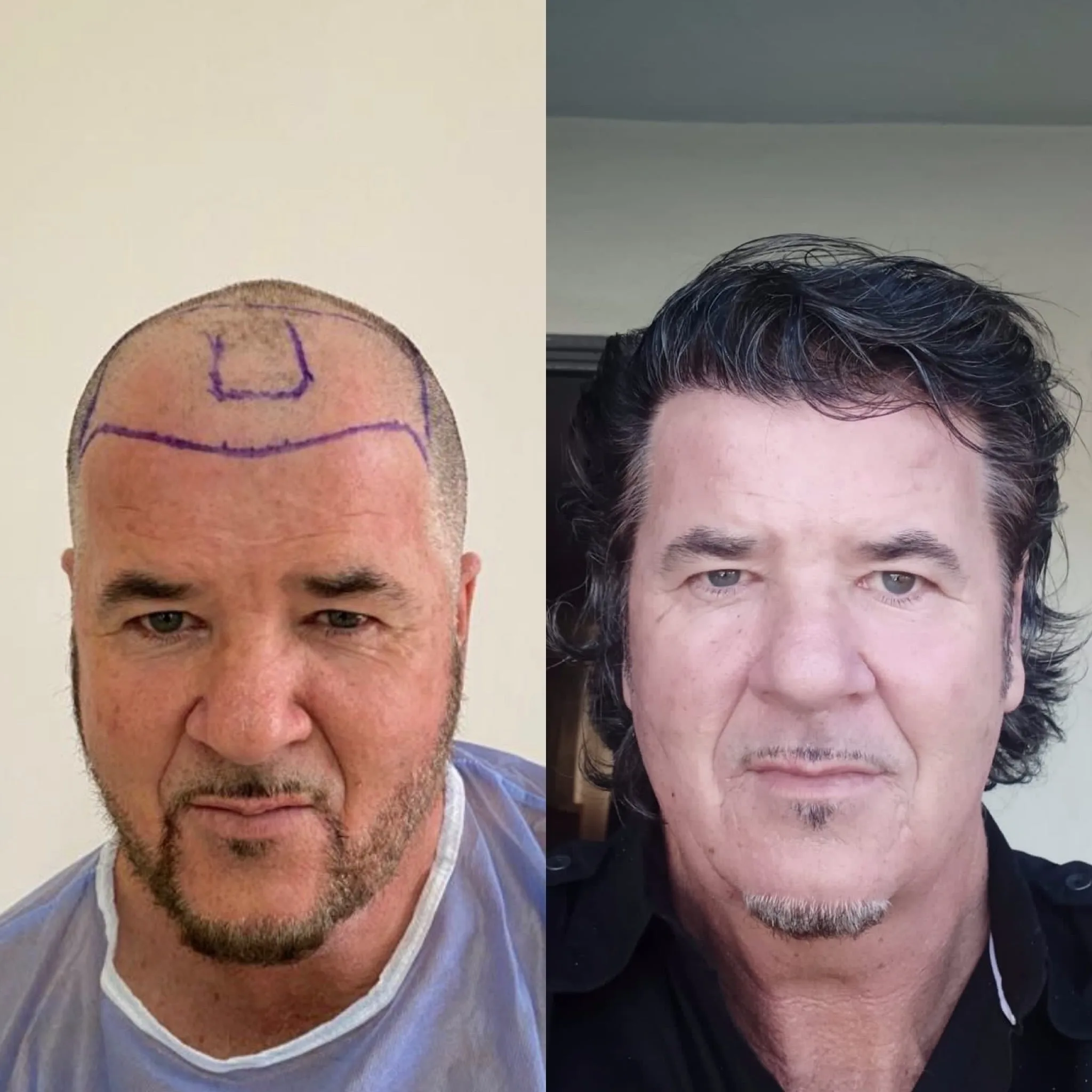 Hair Transplant patient before after 3