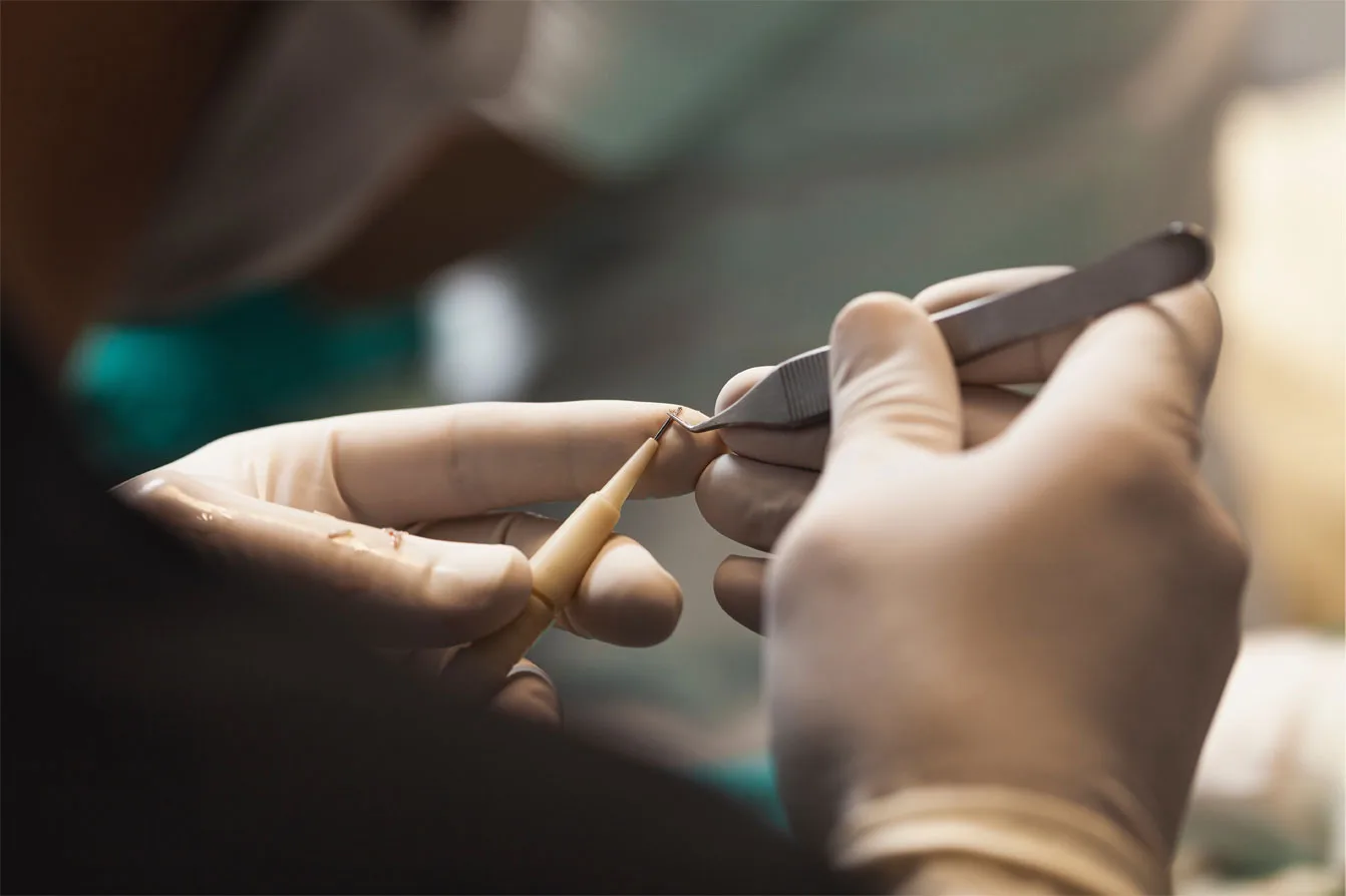 DHI transplant choi Pen