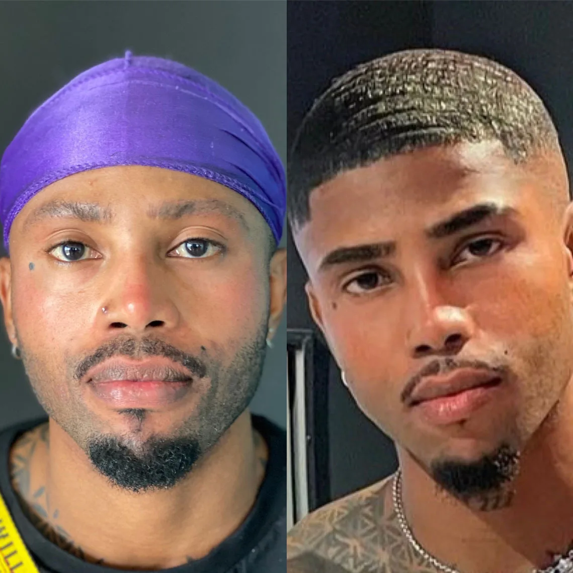 Hair Transplant patient before after 8