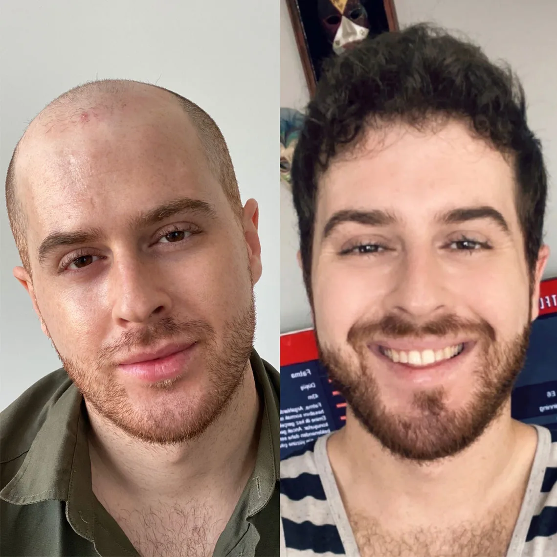 Hair Transplant patient before after 13