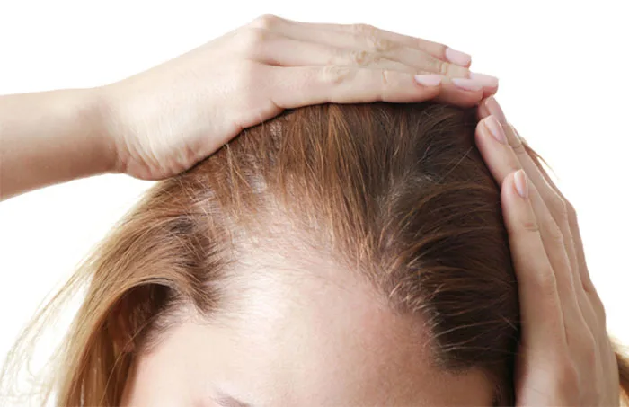 Hair Loss For Women