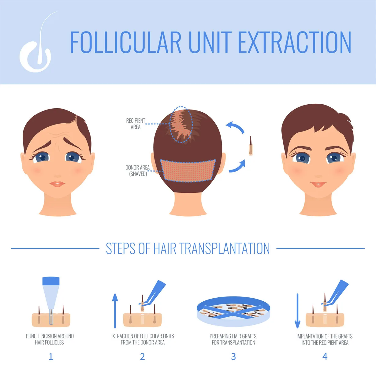 Sapphire Fue Transplant For Women