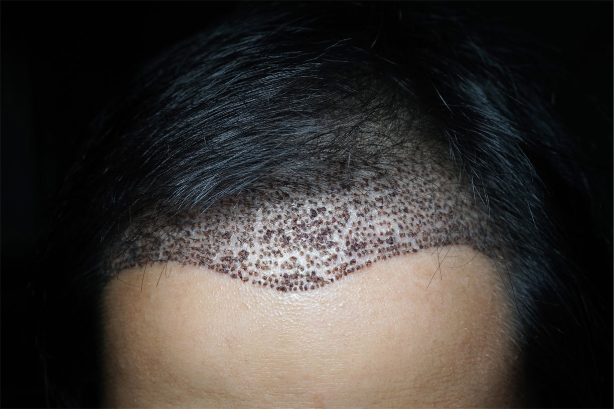 DHI Hair Transplant Method