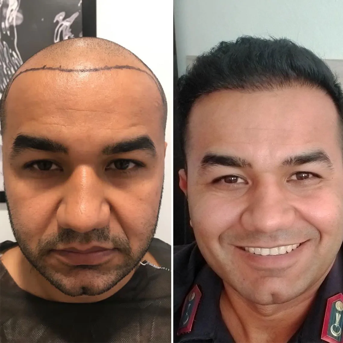 Hair Transplant patient before after 12