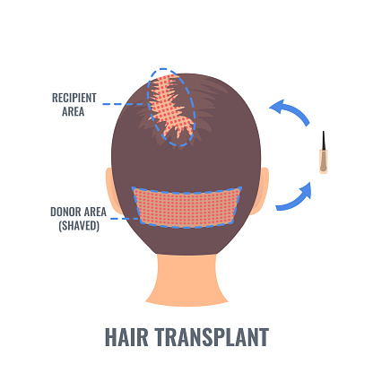 FUE hair transplant donor area