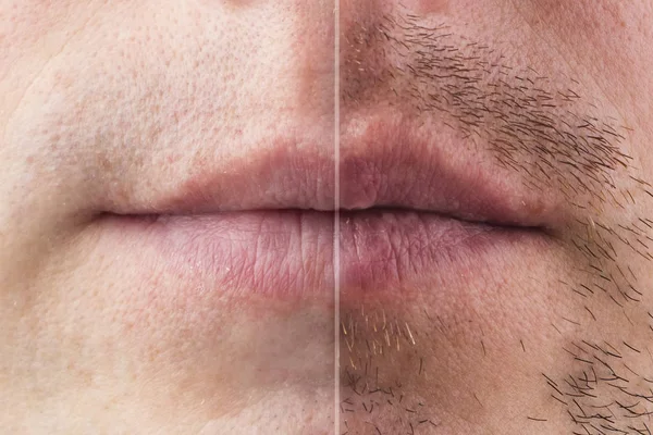 Beard and Mustache Transplantation Procedure