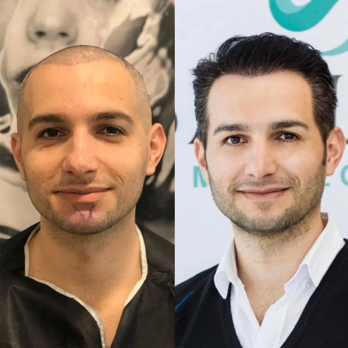Hair Transplant patient before after 14