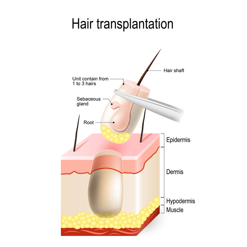 DHI Hait Transplant Stages of All