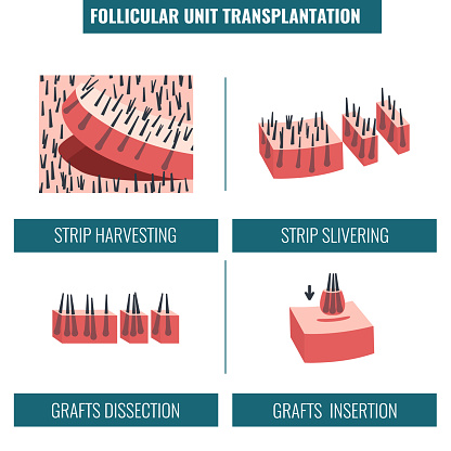 FUT hair transplantation procedure stages medical infographics