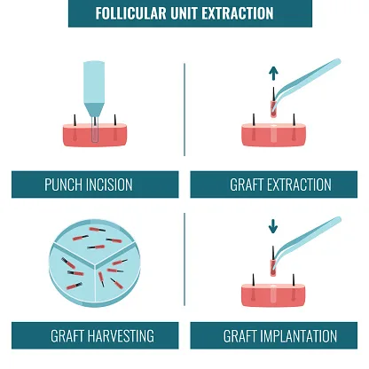 FUE hair transplantation procedure stages medical infographics